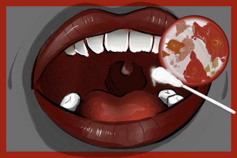 Скрытый за щекой: что может показать образец буккального эпителия – Кровь5